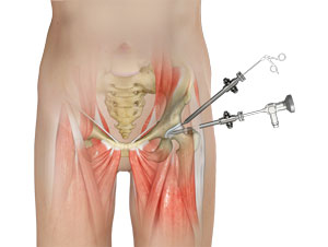 Hip Arthroscopy