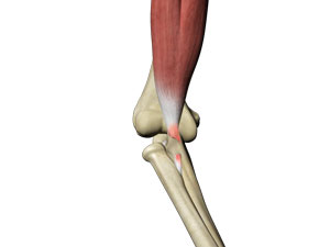 Biceps Tendon Repair