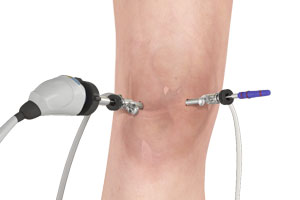 Arthroscopy of the Knee Joint