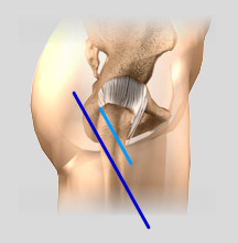 Minimally Invasive Hip Replacement Incisions