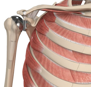 Shoulder Joint Replacement